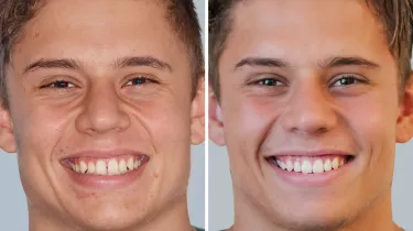 Spark Aligners before-after results